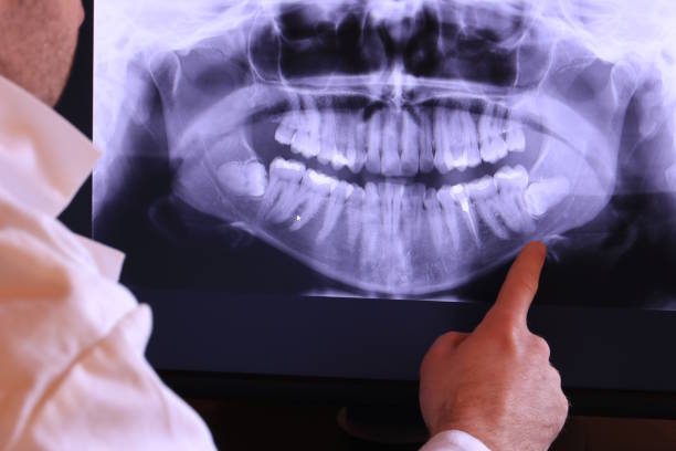 Best Emergency Dentist for Knocked-Out Tooth in West Ishpeng, MI